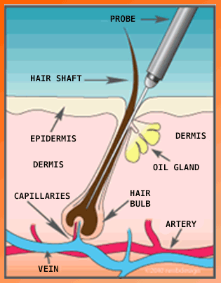 Electrolysis Permanent Hair Removal