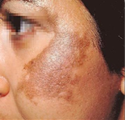 Hyperpigmentation