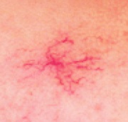 Telangiectasia