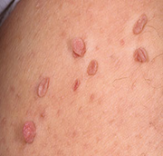 Skin Tag acrochordon