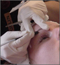 Electrolysis Hair Removal